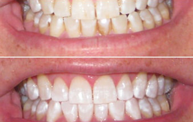 Before & After Treatment