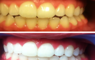 Before & After Treatment