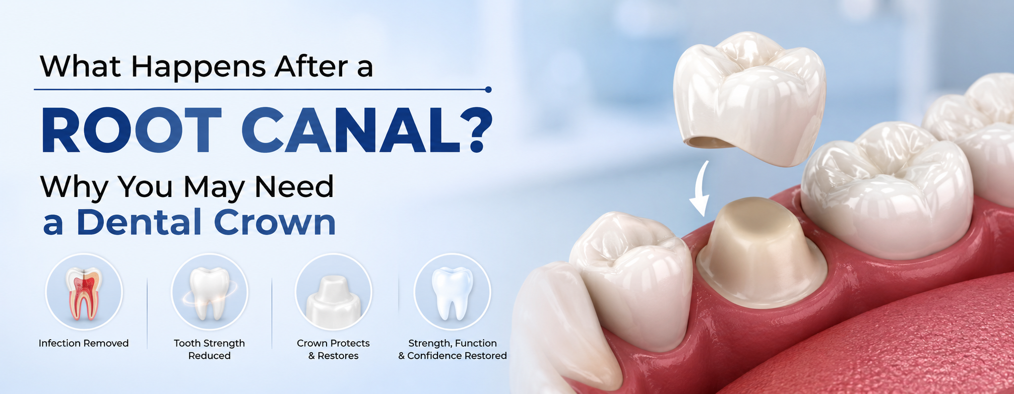 What Happens After a Root Canal? Why You May Need a Crown